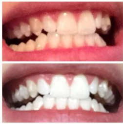 mint for teeth